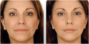 Liquid-Facelift_Restylane_Before-After