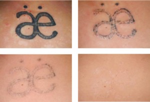 tattoo-removal-in-4-sessions
